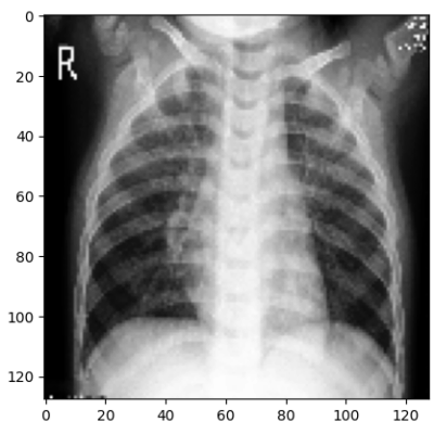 Anonymous X-ray for Covid-19 evaluation machine learning model